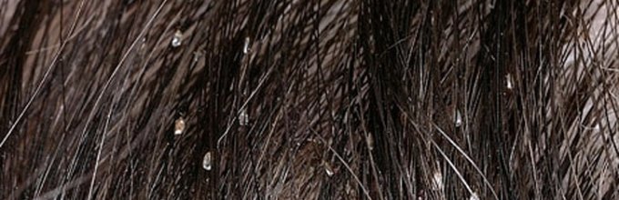 Как выглядят вши и продукты их размножения — гниды на волосах человека